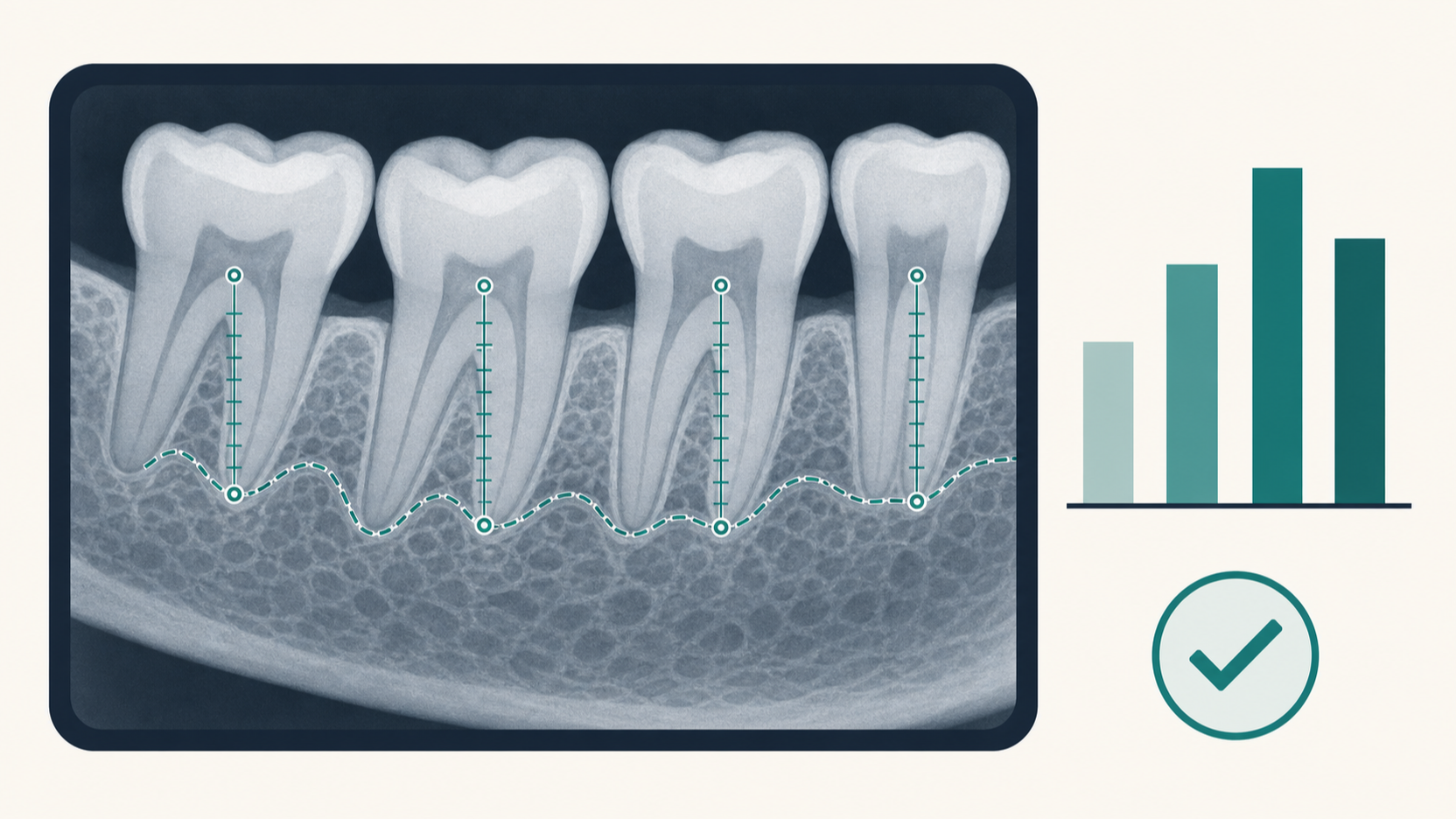 AI measuring dental bone levels on an x-ray